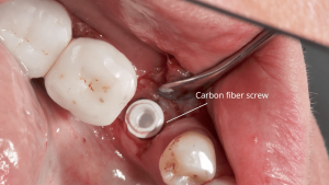 Zirconia Implant